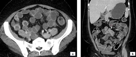 Computed Tomography Enterography Showing A Mucosal Hyperenhancement