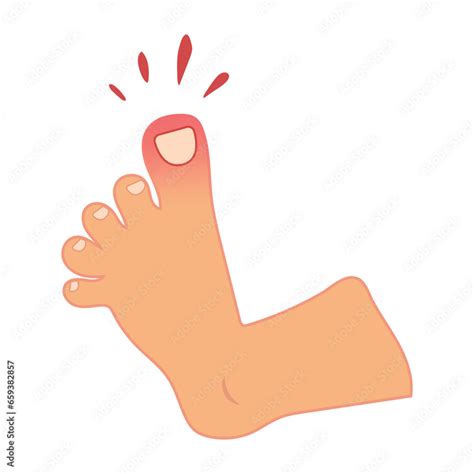 Cartoon Foot With Swollen Stubbed Toe Pain And Trauma Vector