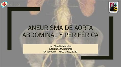 Aneurisma De Aorta Abdominal Y Perif Rica Claudio Rodrigo Morales Udocz