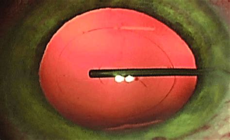 Injection Of Ophthalmic Viscosurgical Device Through The Carefully