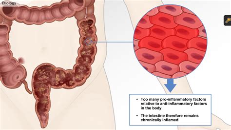 Understanding Ulcerative Colitis A D A M Ondemand