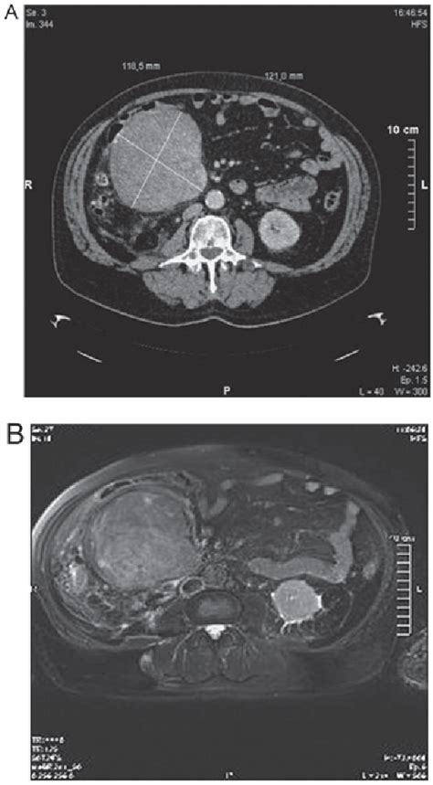 Figure 1 From Robotic Resection Of A Giant Retroperitoneal