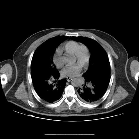 Saddle Pulmonary Embolism Image