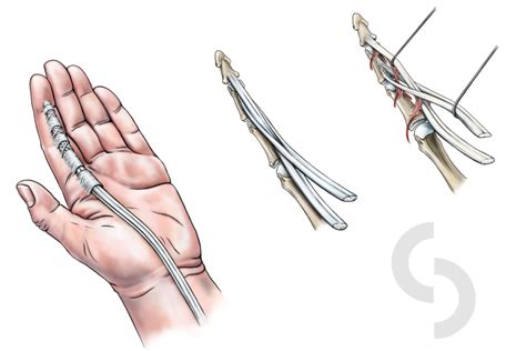 Tendon Injuries Dr Sonja Cerovac