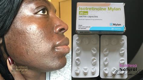 Isotretinoin Ro Accutane Journey 20mg Month 4 Results Dark Skin