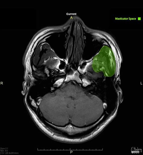 Deep Spaces Of The Head And Neck Annotated Mri Radiology Case