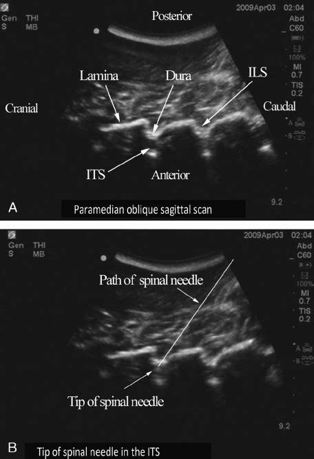 The Pig Carcass Spine Phantom A Paramedian Oblique Sagittal Sonogram