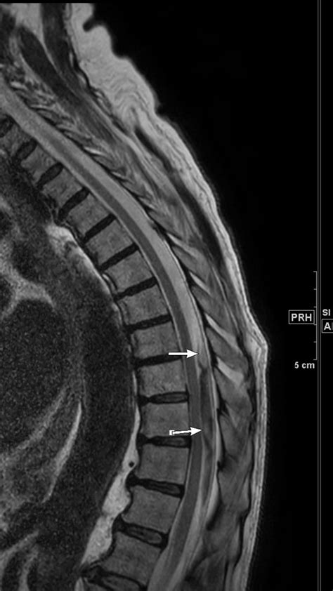 Subdural Spinal Haematoma After Epidural Anaesthesia Bmj Case Reports