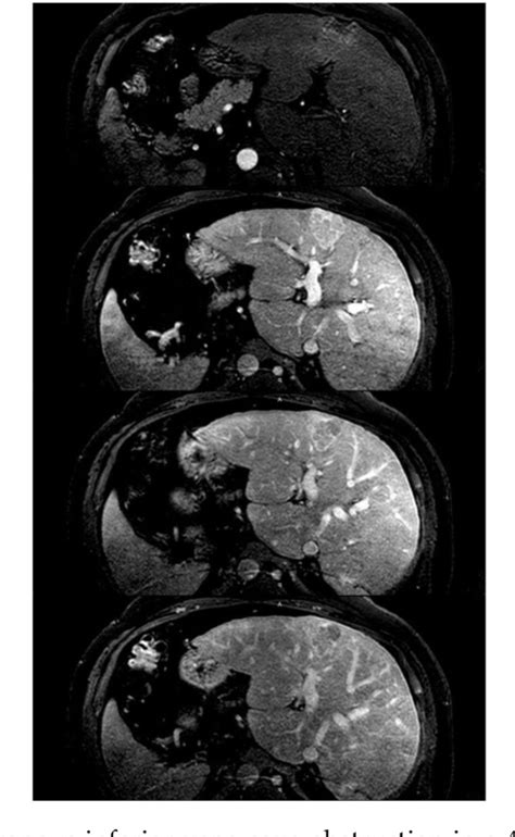 Figure 1 From Congestive Hepatopathy Semantic Scholar