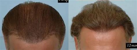 Hair Plug Redistribution Success | 541 Grafts Before & After Photos