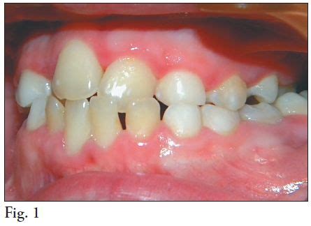 La Enfermedad Periodontal Asociada Al Paciente Con S Ndrome De Down