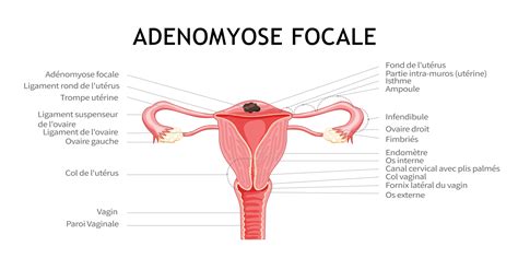 Adénomyose causes symptômes et traitements