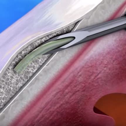 Xen Gel Stent For Glaucoma New Glaucoma Treatments