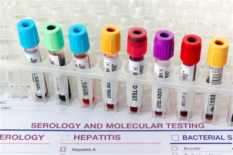 Rack Of Tubes With Blood Samples From Patients In The Serology Test Lab