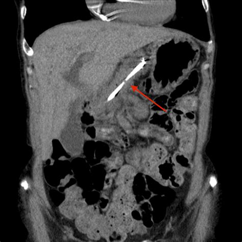 Eus Guided Rendezvous Technique For Pancreas Divisum Videogie