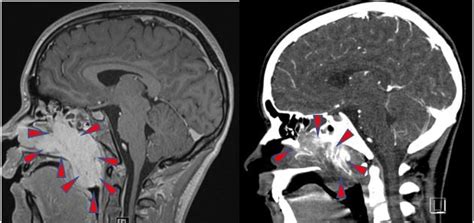 Nasopharyngeal Angiofibroma Radiology