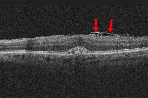 Medicine:Epiretinal membrane - HandWiki