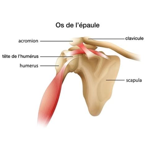 Conflit Sous Acromial Chirurgien De L Paule Et De La Main