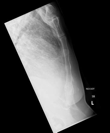 Sternal Fracture Radiology Case Radiopaedia Org