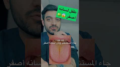 طفل لسانه اصفر 😱🍏 دكتورنبهان Learning Youtube