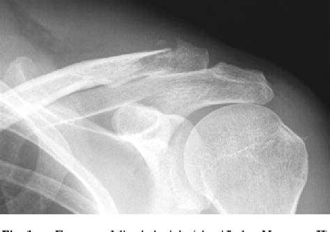 [PDF] Management of distal clavicle fractures. | Semantic Scholar