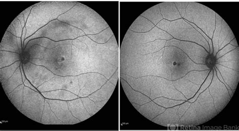 Macular Telangiectasia Type 2 Retina Image Bank