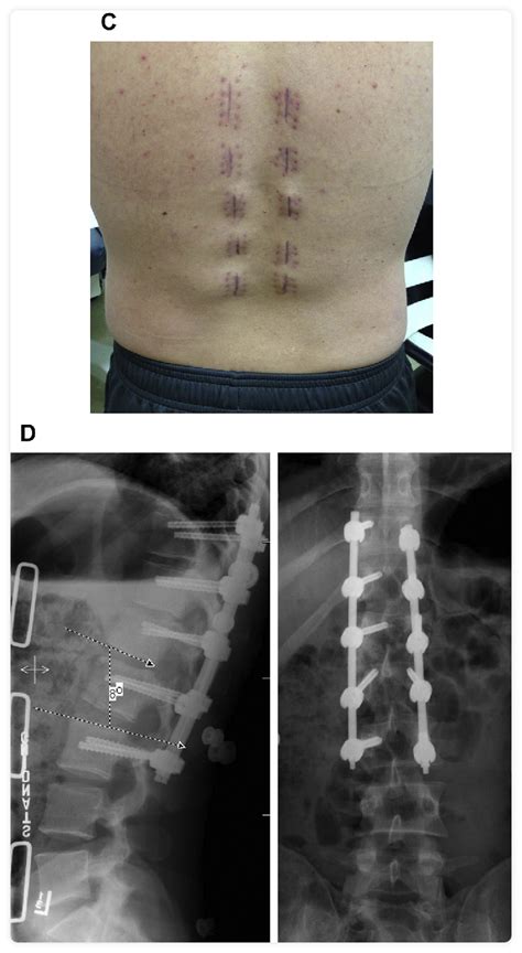 Artrodesis Lumbar Posterior Neuroqx Canarias