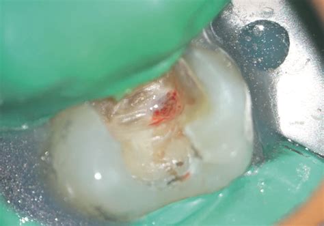 Direct Pulp Capping As A Conservative Procedure To Maintain Pulp Vitality