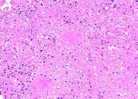 Lymph Node Biopsy Section Showing Patchy Areas Of Necrosis Download Scientific Diagram