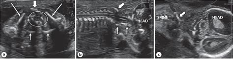 Figure 1 From Prenatal And Neonatal Ultrasound And Magnetic Resonance Imaging Diagnosis Of