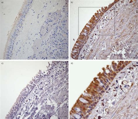 Expression Of Osteopontin Opn In The Bronchial Tissue Of Patients