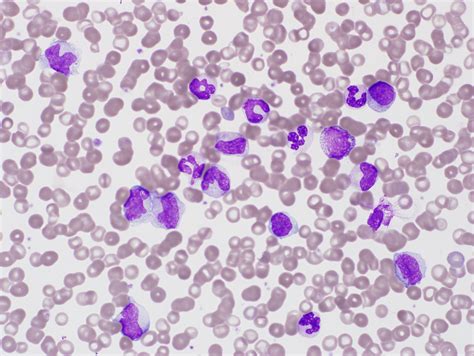 Reactive Lymphocyte Vs Monocyte