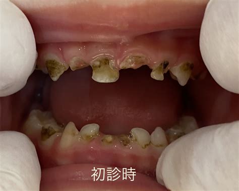 エンゼル歯科 院長にっき 子どもの虫歯（むし歯）を少ない回数で確実に治療する