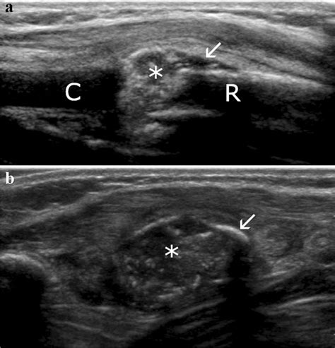 Langerhans Cell Histiocytosis Of The Left Th Rib In A Year Old Boy