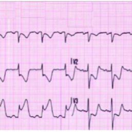 ECG showed sinus rhythm with ST segment elevation in leads II, III, and ...