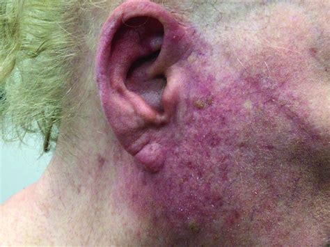 A Woman With Scaling And Painful Crusted Erythematous Papules And Pustules On Her Face