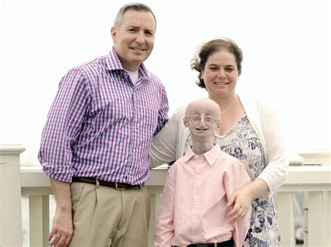 Progeria Sam Berns