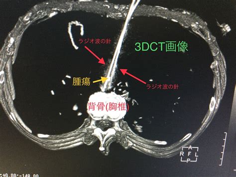 【お腹の一番深い所の肝臓ガンをラジオ波で治療】 四日市消化器病センター