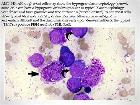 Department Of Pathological Anatomy Acute Myeloid Leukemia Prepared