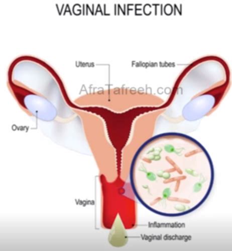 Vaginitis Flashcards Quizlet