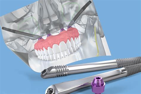 Zigoma İmplant - Dentallaid