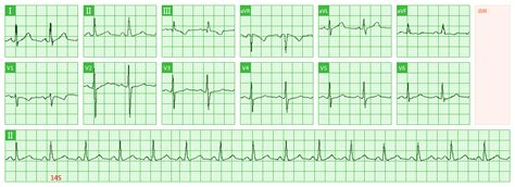 心电图知识：窦性心律与窦性心律不齐