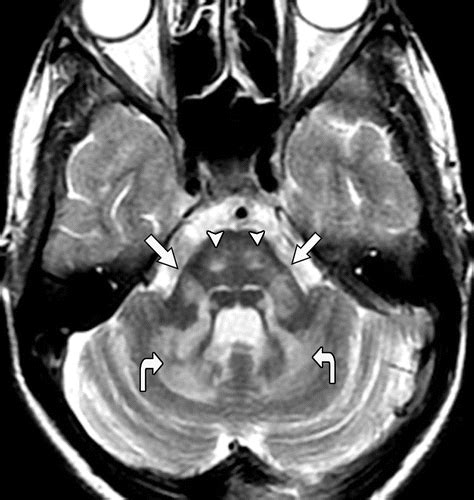 Adult Leukodystrophies A Step By Step Diagnostic Approach RadioGraphics