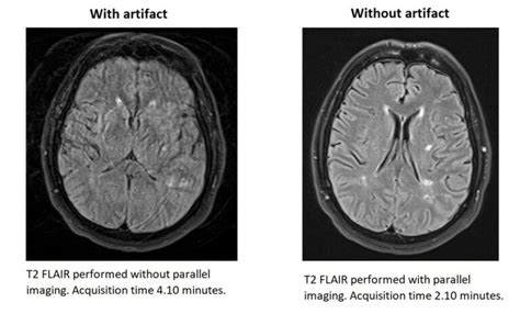 Mri Artifacts Mri Motion Artifact Ghosting Artifact Mri