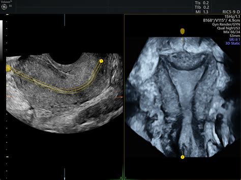 The Benefits Of Endometrial Ablation For Endometriosis Empowered