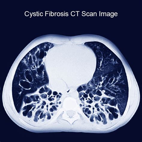 Cystic Fibrosis Causes, Signs, Symptoms and Treatment