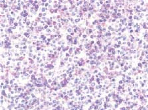 T Cell Histiocyte Rich Large B Cell Lymphoma The Majority Of Cells Are Download Scientific