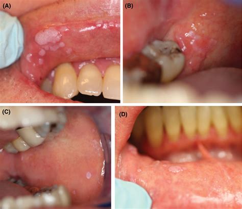 Oral Photographs Of Widespread Focal Epithelial Hyperkeratosis Or