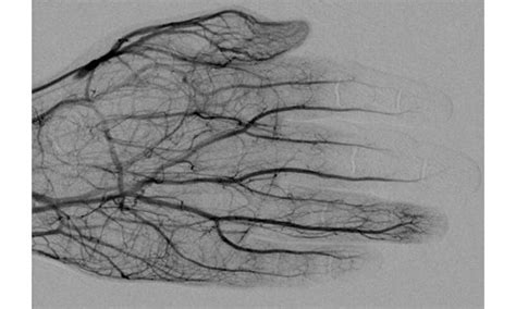 What interventional radiologists need to know about frostbite and ...