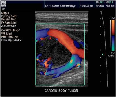 Vascular Test 1 Flashcards Quizlet